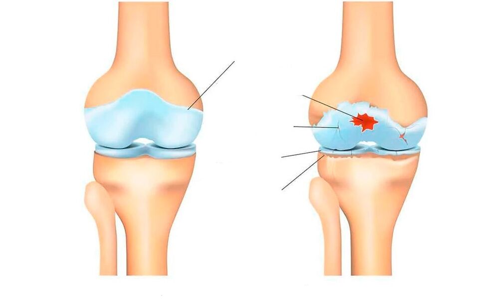zdrowy staw i przy artrozie