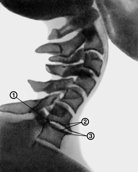 Rentgen kręgosłupa szyjnego z osteochondrozą