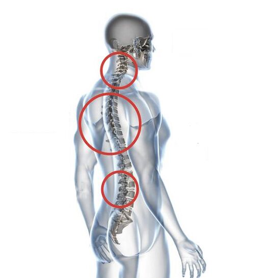 Jak objawia się osteochondroza