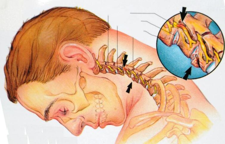 objawy osteochondrozy szyjnej