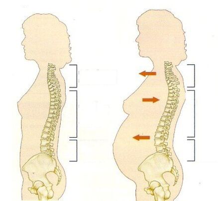 osteochondroza podczas ciąży