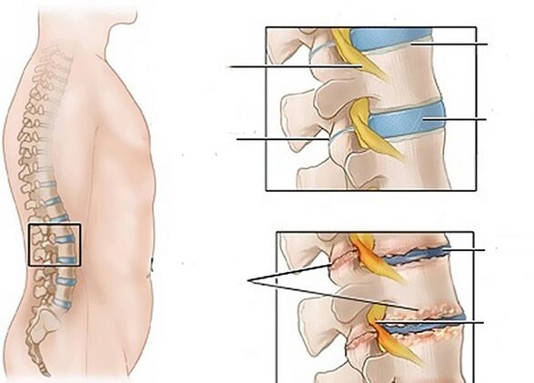zmiany w dyskach z powodu osteochondrozy